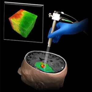 Optička sonda za uklanjanje tumora mozga