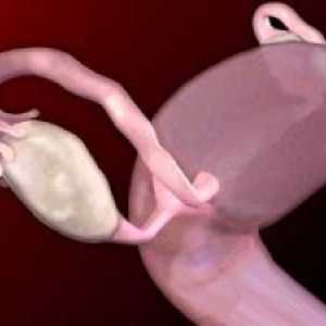Jajnika tumora kod žena benignih i malignih: simptomi, liječenje, simptomi, uzroci