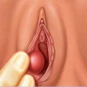 Tumori vagine