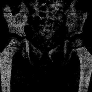 Osteolize erozije kosti