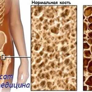 Osteomalacija. Osteoporoze i karakterizacija osteoporoze