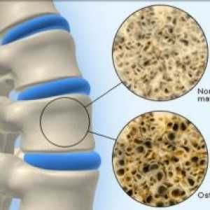 Osteoporoza kosti: liječenje, simptoma, uzroci, simptomi, prevencija, dijagnoza