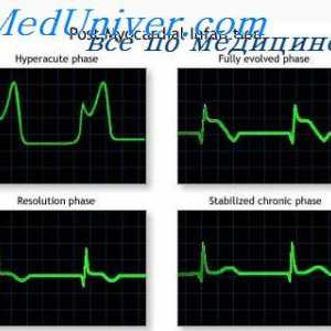 Akutna faza infarkta prednjeg zida. Infarkt stražnji zid miokarda na EKG