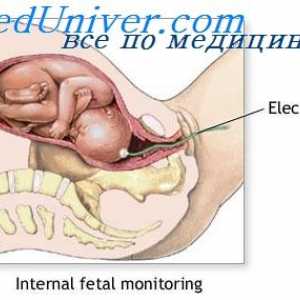 Odreda i porod posteljice. Bol tijekom poroda