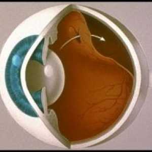 Odvajanje mrežnice očiju: uzroci, simptomi, liječenje, simptomi