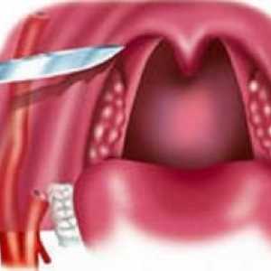 Peritonzilarnog apsces: liječenje, simptomi, uzroci, simptomi