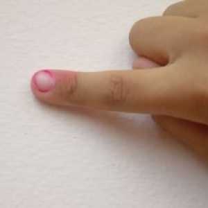 Zanoktica prst: tretman kod kuće, razlozi