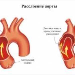 Aorte patologija u trudnoći