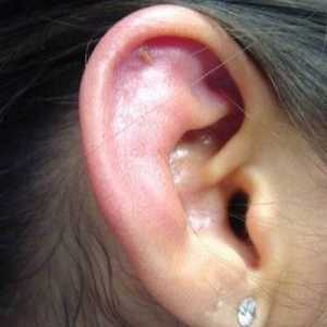 Perichondrium uha: liječenje, simptomi, znakovi, uzroci