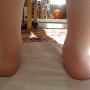 Ploskovalgusnaya stopala u djece, liječenje