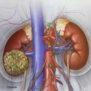 Karcinom bubrežnih stanica: liječenja, simptomi, uzroci, simptomi