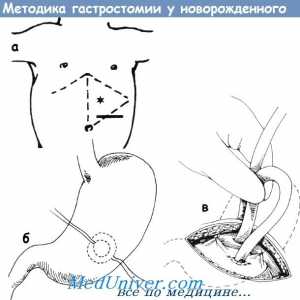 Gastrostomy tehnika u novorođenčeta