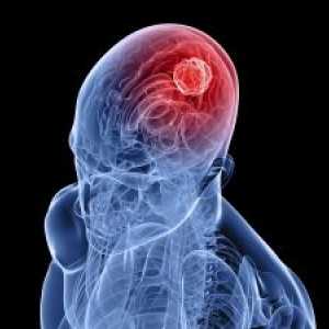 Lezije vidnog puta u tumorima cerebralne hemisfere