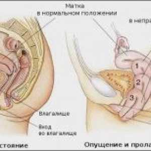 Malformacije maternice: dijagnoza i liječenje