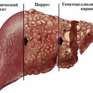 Opisthorchiasis posljedice u odraslih, utjecaj na ljudsko tijelo