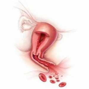 Postpartum krvarenje: uzroci, liječenje, prevencija