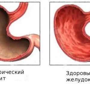 Primjena Maalox gastritis
