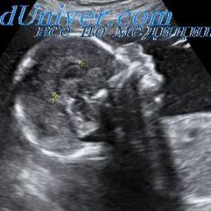 Prognoza cistične hygroma u fetusa. Procjena nuhalni nabor