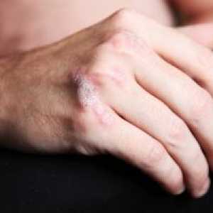 Psorijatični artropatija, liječenje, simptomi, znakovi, uzroci