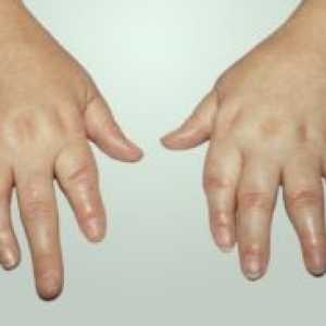 Psorijatični artritis: liječenja, simptomi, dijagnoza, simptomi, uzroci