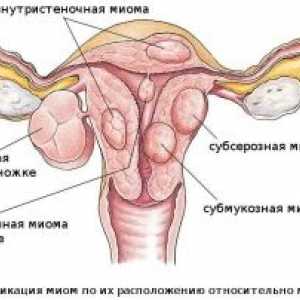 Raka maternice: stadij simptoma, liječenje, dijagnozu