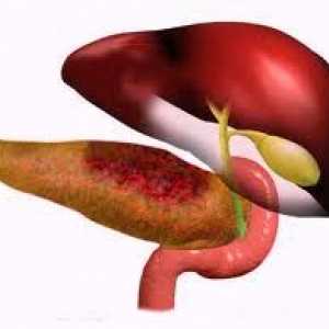 Povratni pankreatitis, rekurentne akutni ili kronični oblik