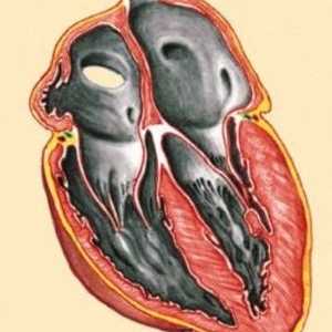 Restriktivna kardiomiopatija
