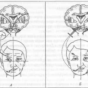 Uloga facijalnog živca u manifestacijama boli lica