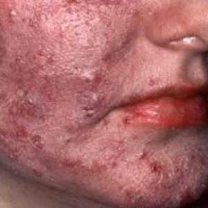 Koža rosacea: liječenje, simptomi, uzroci, simptomi