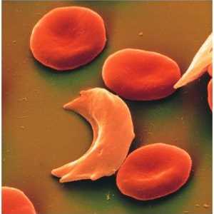 Anemija srpastih stanica: simptomi, uzroci, liječenje, simptomi