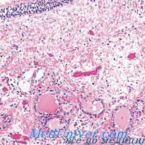 Sifilis štitnjače morfologija, patološko anatomija