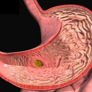 Simptomi gastritisa i liječenje