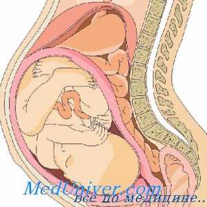 4P sindrom. Triploidija u fetus