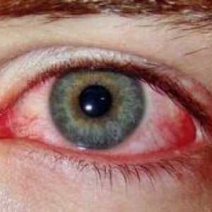 Sindrom crvenih očiju: Tretman