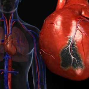 Sindrom iznenadne srčane smrti