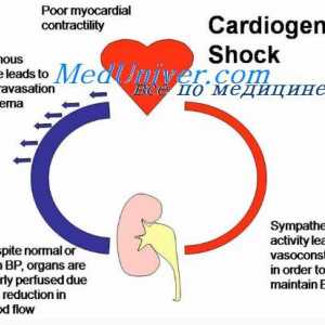 Kardiogeni šok. Fiziologija liječenje kardiogeni šok