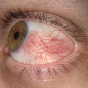 Sklerozu očiju: liječenje, simptomi, uzroci, simptomi