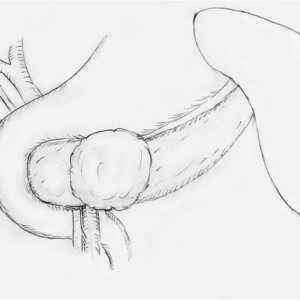 Pseudopapillary-čvrsti tumor gušterače