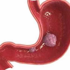 Stromalnih tumora gastrointestinalnog trakta: simptomi, liječenje, simptoma