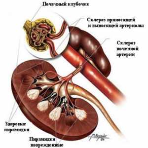 Krajnji stadij bubrežne bolesti (kroničnog zatajenja bubrega), dijabetes