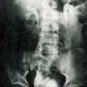 Trauma trbuha i urinarnog trakta. oštećenja mokraćovoda