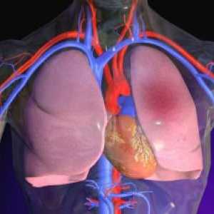 Plućna embolija (PE): simptomi, liječenje, hitnu skrb, dijagnoza, uzroci, simptomi