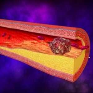 Tromboza arterije gornjih ekstremiteta