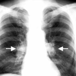 Tuberkuloza intratorakalnih limfnih čvorova: liječenje, komplikacije, uzroci, simptomi
