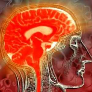 Sušičava upala moždanih ovojnica, oštećenja središnjeg živčanog sustava
