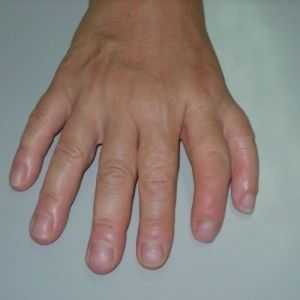Udvostručenje prvi prst (ili greda preaxial Polydactyly)