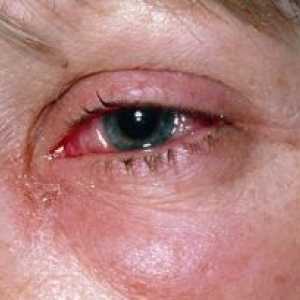 Modrice i ozlijedio oči: liječenje, prva pomoć, uzroci, simptomi, znakovi