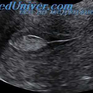 Uzi jajovodi. Transvaginalni ultrazvuk okruglih ligamenata i crijeva