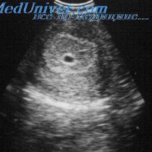 Ultrazvuk u prvom tromjesečju trudnoće. Indikacije za transvaginalni ultrazvuk u prvom tromjesečju…