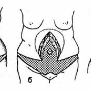 Vertikalni Abdominoplastika. Značajke Abdominoplastika ako postoji ožiljaka od prednjeg trbušnog…